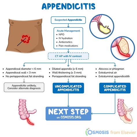 appendicitis uptodate